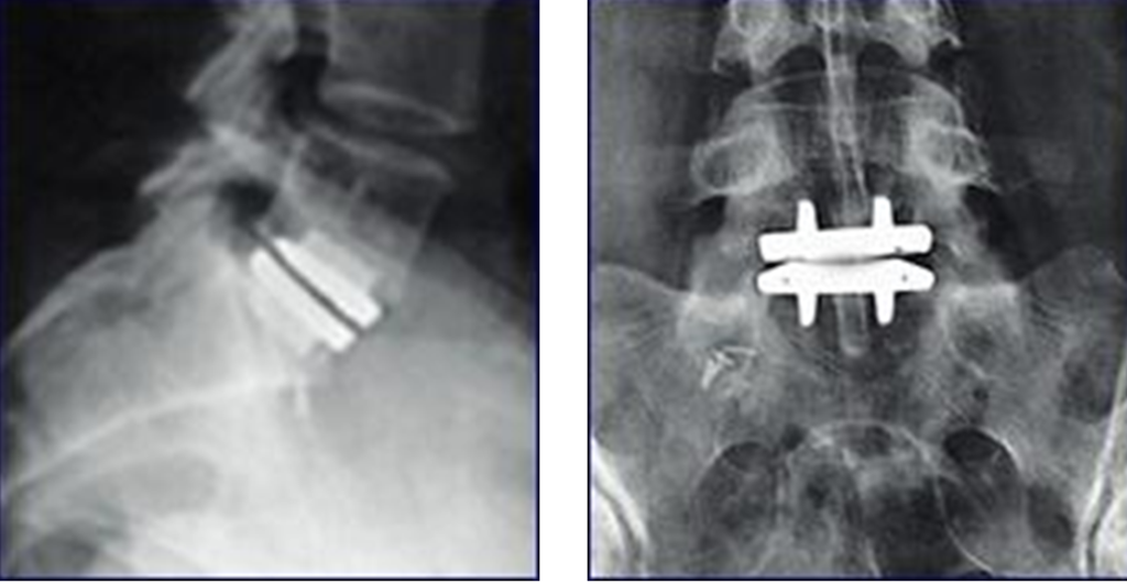 Artificial Lumbar Disc Surgery Reno Orthopedic Center