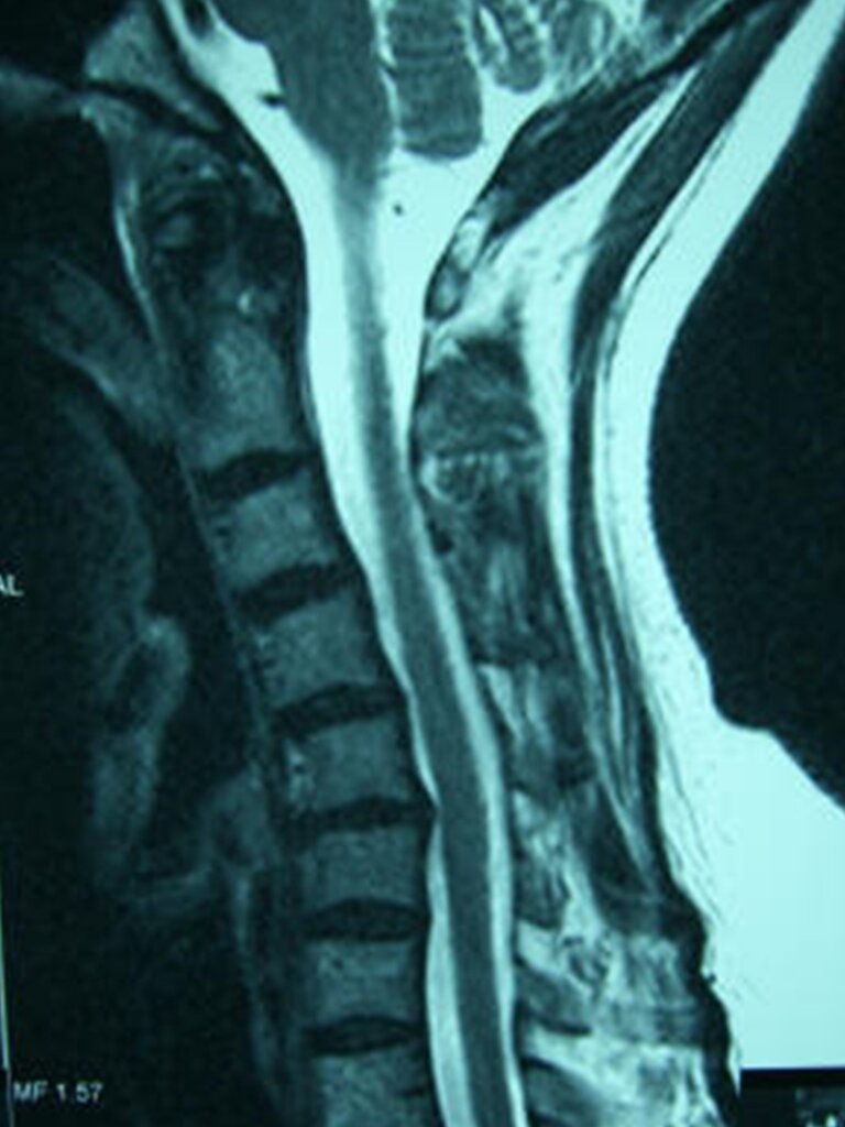 Anterior Cervical Fusion Reno Orthopedic Center   Anterior Cervical Fusion 1 768x1024 