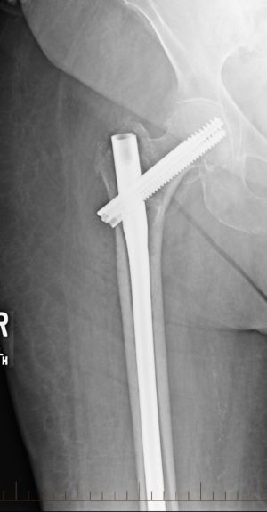 Hip Fracture Treatment Without Surgery