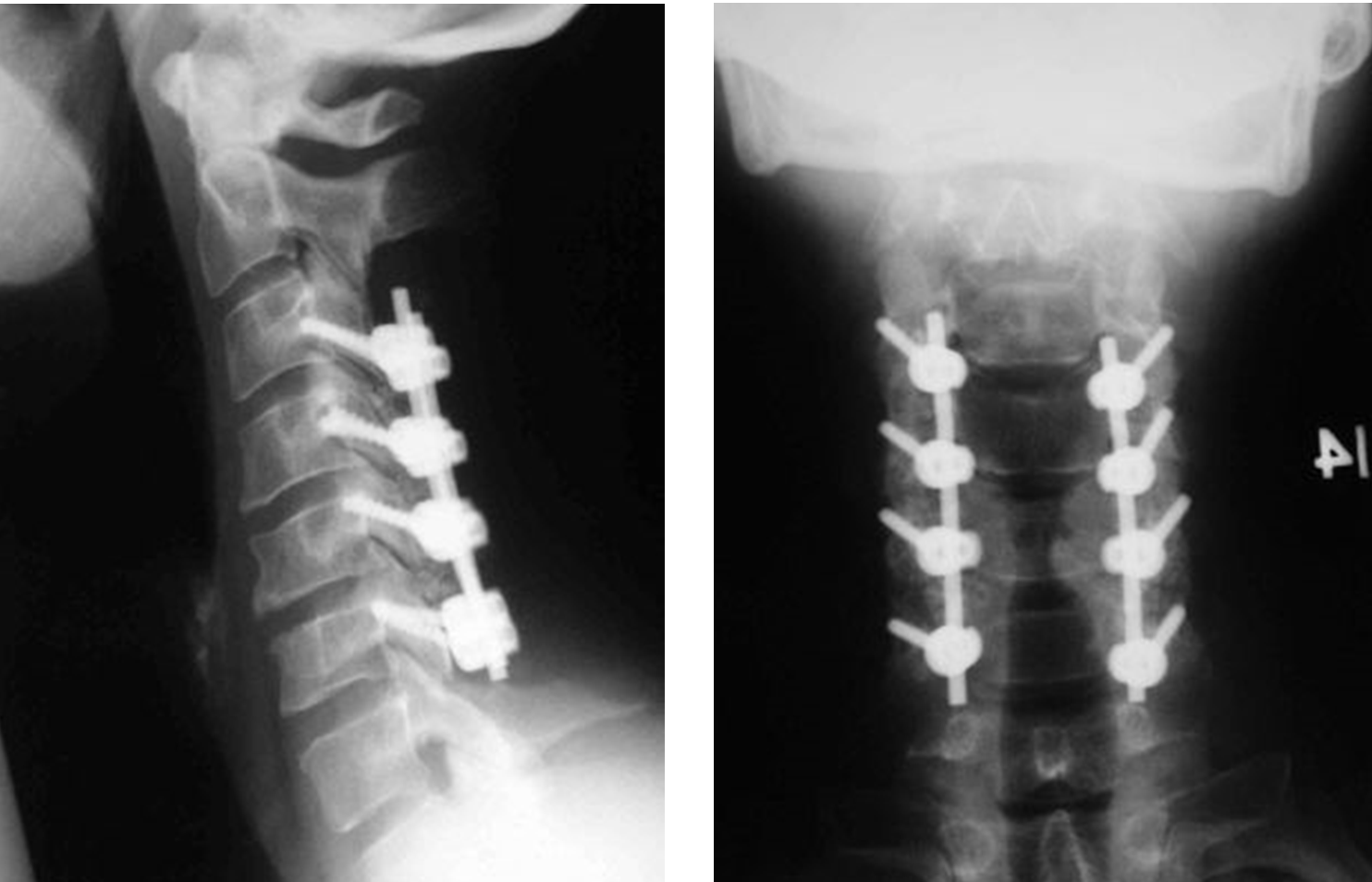 normal healthy cervical spine x ray