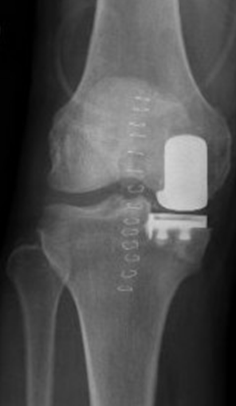 What Is Normal Recovery Time For Partial Knee Replacement