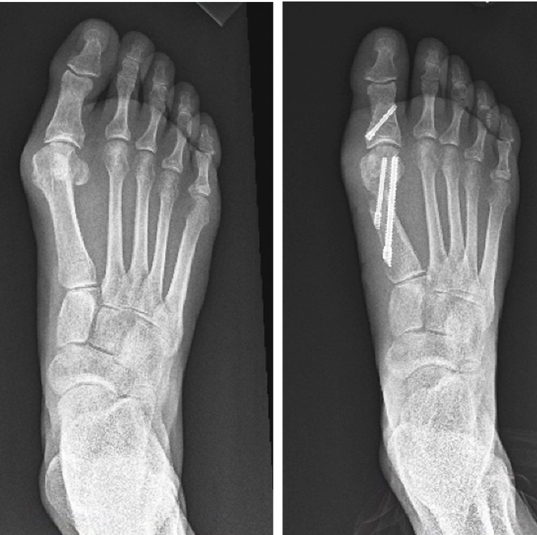 Minimally Invasive Foot & Ankle Surgeries | Reno Orthopedic Center