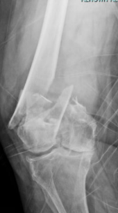 Distal Femur Fracture Postoperative Protocol - Reno Orthopedic Center