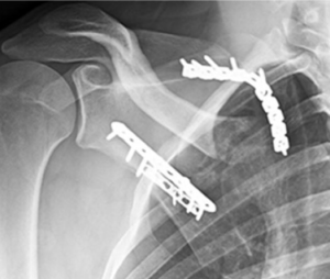 Scapular Fracture (Broken Shoulder Blade)