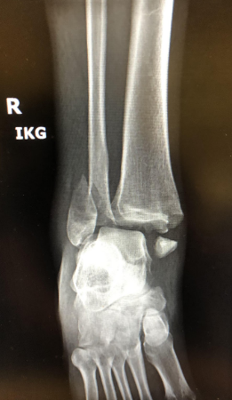 Broken Ankle - Reno Orthopedic Center